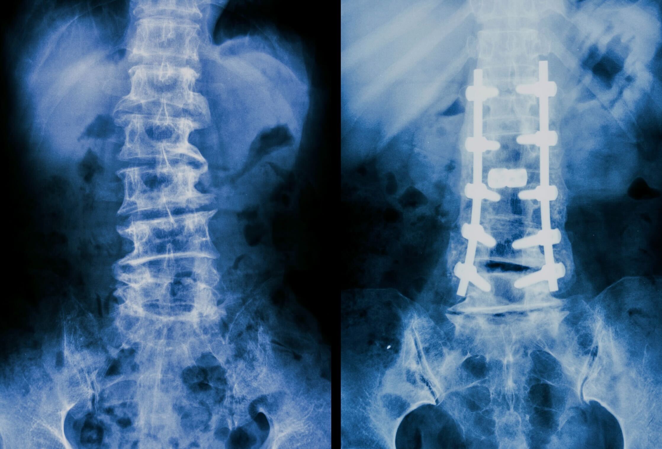 Spine X-ray showing before and after surgery comparison